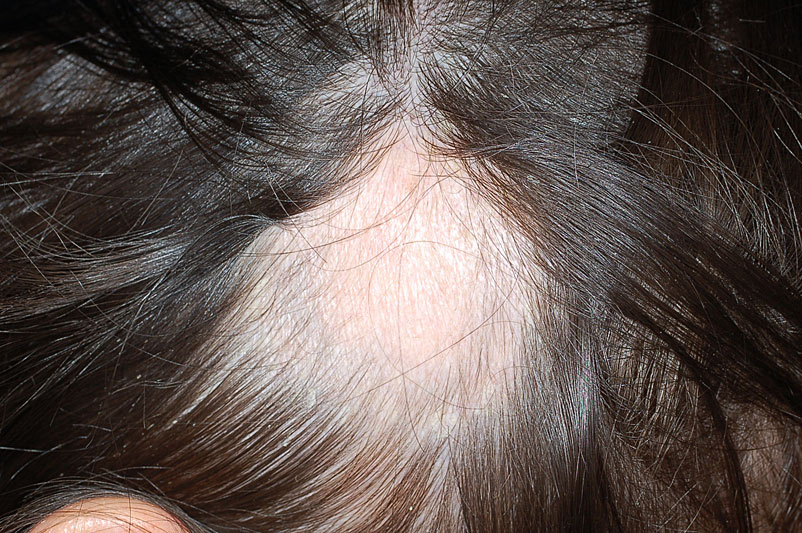 Hair Disorders Circular Hair Loss DermAllegra